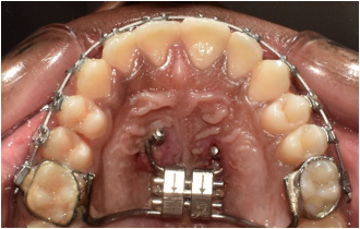Placement of hybrid hyrax for disarticulation of the circum- maxillary sutures.