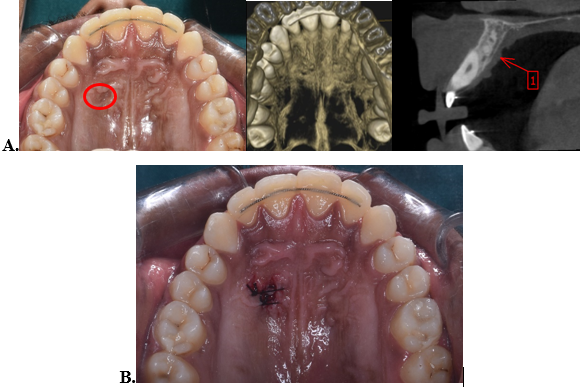 A. Soft tissue scarring in the implant site; CBCT images of the maxilla; localised periapical lesion near Canalis Sinuosus in the anterior maxilla. B. Surgical excision of scar.
