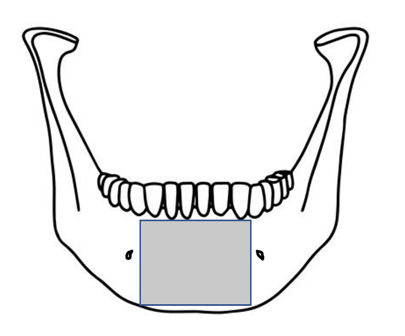 The symphyseal borders extended 5 mm anterior to the mental foramen