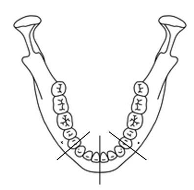 The linear measurements were made along three slices: 1) At the facial midline, 2) 5 mm mesial to the right mental foramen 3) 5 mm mesial to the left mental foramen