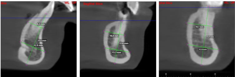 Symphyseal measurements done for samples of HGP along the three slices