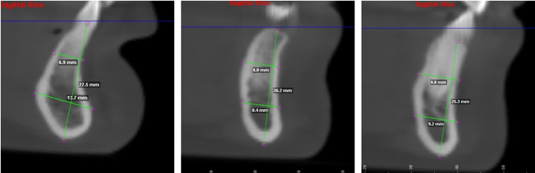 Symphyseal measurements done for samples of AGP along the three slices