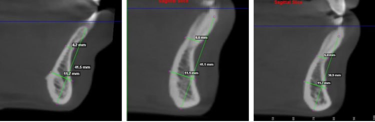 Symphyseal measurements done for samples of VGP along the three slices