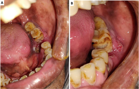 Ulcerproliferative lesion in the mandibular left molar region