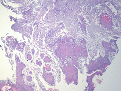Islands and sheets of neoplastic epithelial cells infiltrating into the connective tissuestroma