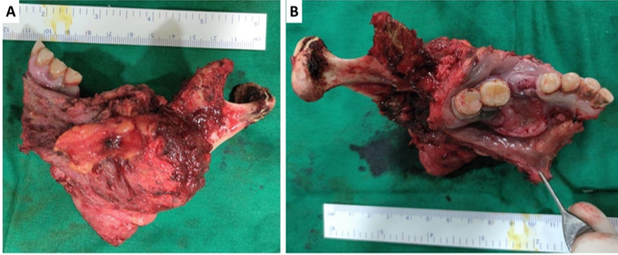 Excised specimen after hemimandibulectomy