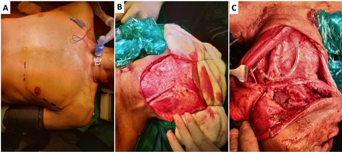 Harvesting of the pectoralis major flap
