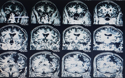 Preoperative MRI Brain