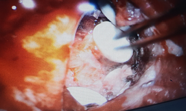 Placement of Glidal wafers in excisedlesion cavity