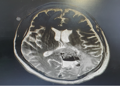 Post operative screening MRI Brain