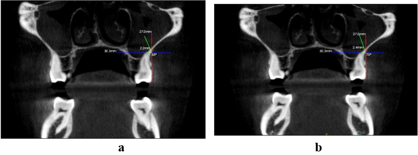 (a): Coronal view screen showing the meeting point of red and blue lines at 65◦. (b): Coronal view screen showing the meeting point of red and blue lines at 70◦.