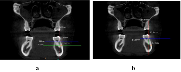 (a): Coronal view screen showing the measurements made at 6mm apical to the CEJ (b): Coronal view screen showing the measurements made at 11mm apical to the CEJ.