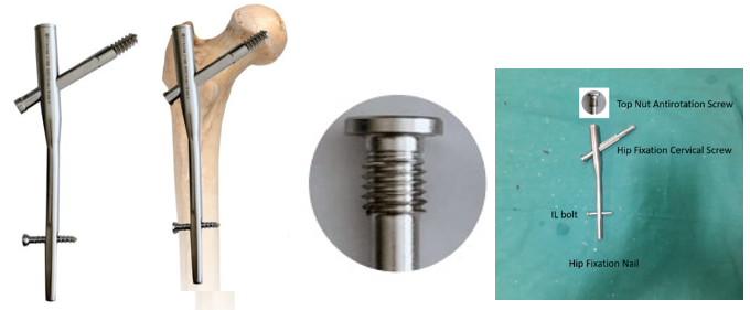 Hip fixation nail and screw with Top nut antirotation screw
