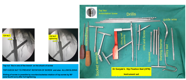 Very simple and limited instrumentation -- surgeon friendly