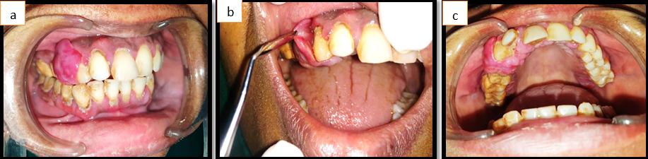 a,b,c:Single, firm reddish pink swelling involving 13,14 buccally and 12-14 palatally with pedunculated base.