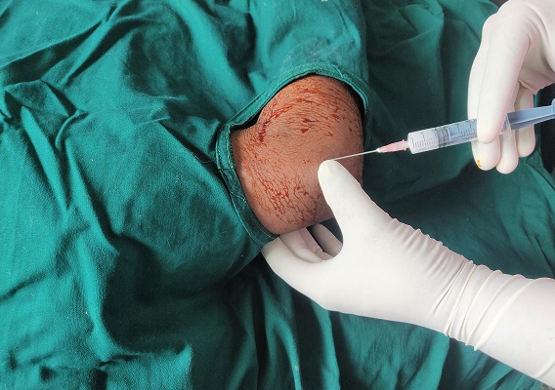 Injection procedure