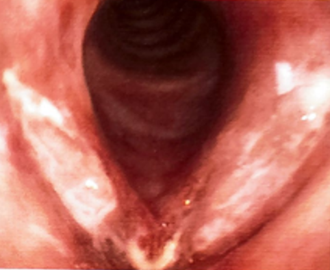 Cobblestoning of vocal cord with whitish plaques