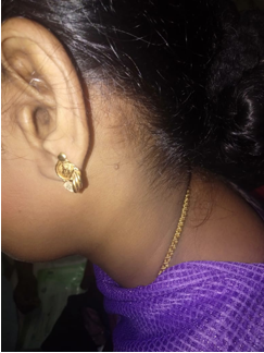 Showing subcutaneous nodule in the left sternocleidomastoid upper 1/3rd