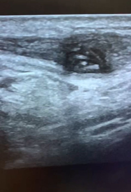USG showing a nodular lesion measuring 10.4 x 6.7 x 6.9 mm in the upper part of left sternocleidomastoid muscle with moving Dirofilarial worms.