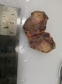 Showing excision biopsy specimen showing Dirofilarial worm measuring 0.5 cm in length