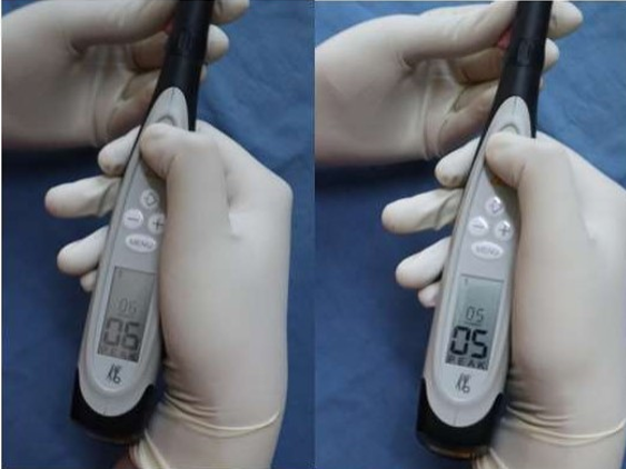 Diagnodent scores of Remineralised teeth