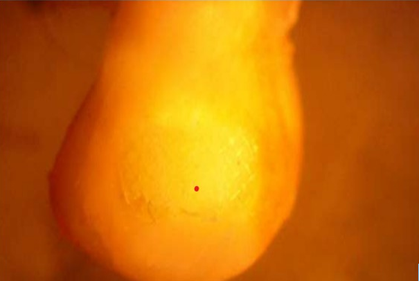 Adhesive Remnant Index score