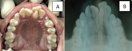 A: Preoperative photograph; B: Maxillary occlusal RG