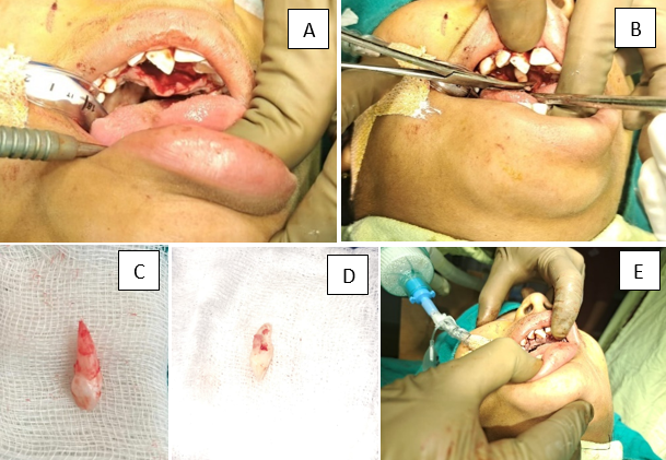 A: Palatal mucoperiosteal flap raise; B: Mesiodens extracted; C and 3D: Mesiodens; E: Suture given