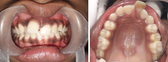 Preoperative intra oral photographs