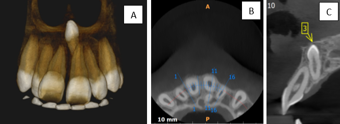 A: Panoramic View; B: Axial Cross section; C: Sagittal cross section