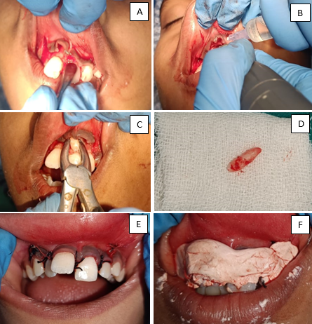 A: Palatal mucoperiosteal flap raise; B: Bone cutting; C and 6D: Mesiodens; E: Suture given; F: COE pack given)