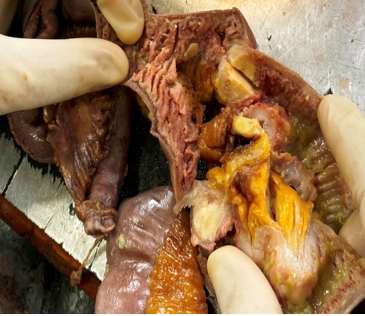 On gross ileum cut openshowing single, yellowish- tan, circumscribed ,round mass with irregular mucosal thickenings with ulceration.