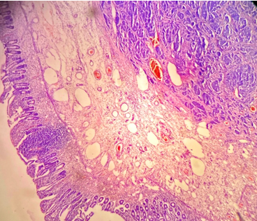Tumor composed of uniform neoplastic cells arranged in solid nests (H& E stain, ×100).