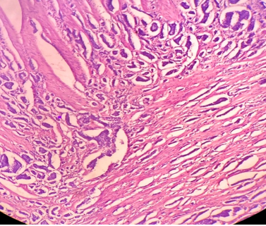 Tumor composed of uniform neoplastic cells arranged in solid nests, tabeculae with invasion in muscle layer. (H& E stain, ×200).