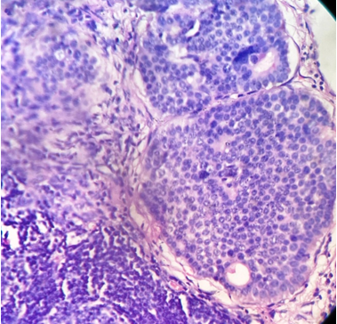 Tumor composed of uniform, round cells having to oval nuclei with salt pepper chromatin. (H& E stain, ×100).