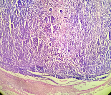 Mesenteric lymph nodes showing tumor metastasis (H& E stain, ×100).