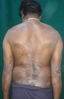 Chronic Plaque Psoriasis