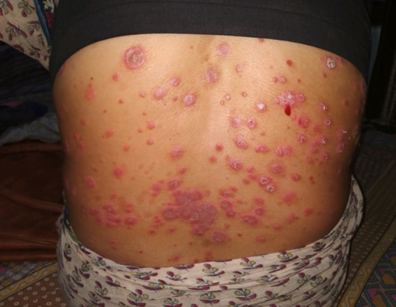 Chronic plaque psoriasis