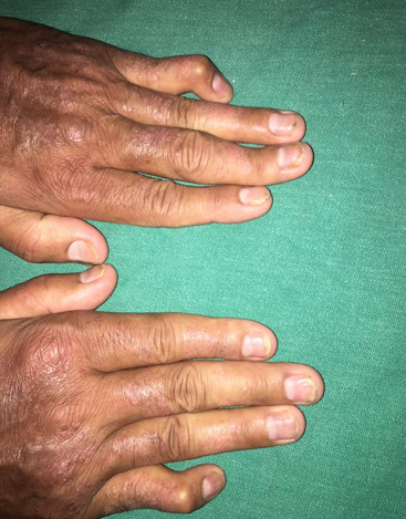 Nail psoriasis with psoriatic arthritis