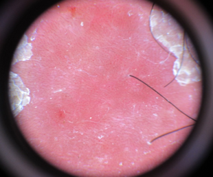 Dermoscopy- Regularly distributed dotted vessels, light red background color and diffuse white scaling.