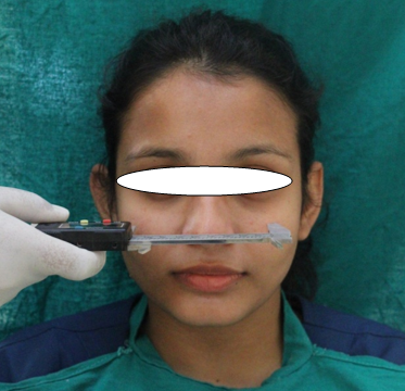 Morphological facial width