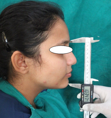 Morphological facial height