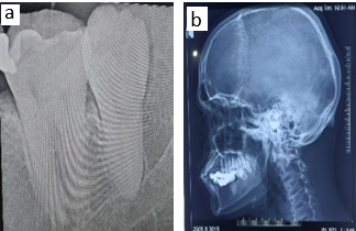 a: Pre-operative intraoral periapical radiograph showing complete vertical impaction in respect to the left mandibular distomolar; b: Pre-operative left lateral skull radiograph showing the impacted distomolar and its relation to the surrounding structures.