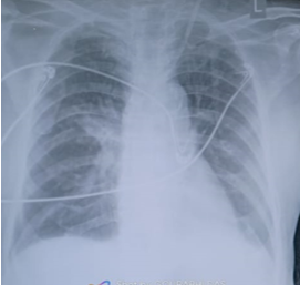 Chest X-ray after two haemodialysis