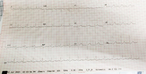 Baseline ECG