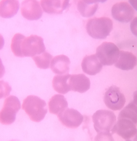Ring-formtrophozoite of P.vivax in a thin blood smear.