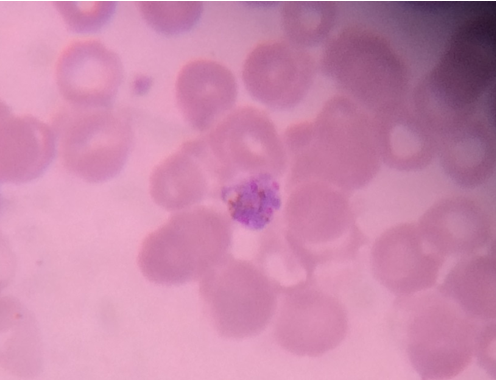 Schizont of P.vivax in a thin blood smear.