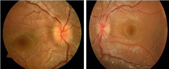 Colour fundus photograph suggestive of optic neuritis both eyes (left>right)