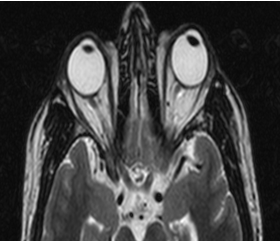 MRI orbit showed tortuosity and altered signal intensity with prominence in cerebrospinal fluid sleeve of left optic nerve (left>right)