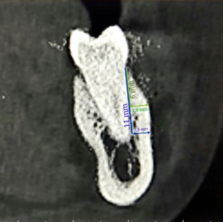 MBS bone thickness measured at 6mm and 11mm vertical distance from the CEJ.